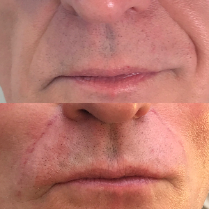 an example of how dermal fillers work