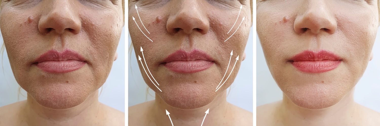 Thread Lift Treatment before and after
