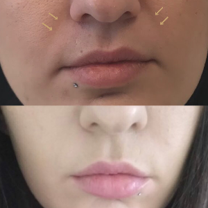 before and after the dermal filler work