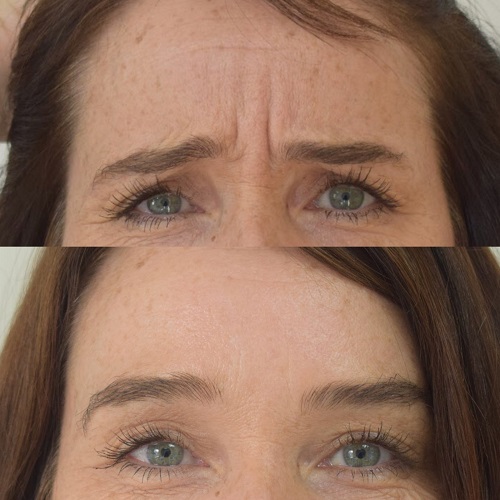 Example of anti-wrinkle treatment - before and after