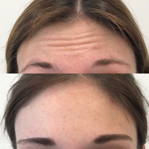 Example of anti-wrinkle treatment completed at our clinic in Altrincham, serving Cheshire & beyond