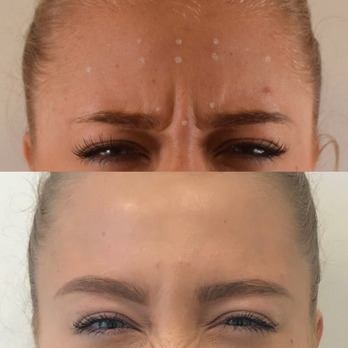 Example of botox treatment - before and after - available in Cheshire and Altrincham