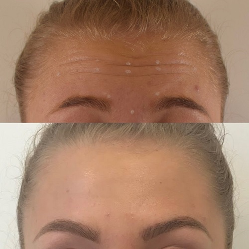 Example of botox treatment in Altrincham, Cheshire