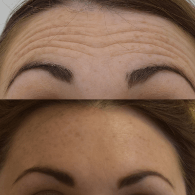 before and after anti-wrinkle injections