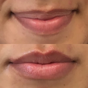 lip fillers before and after
