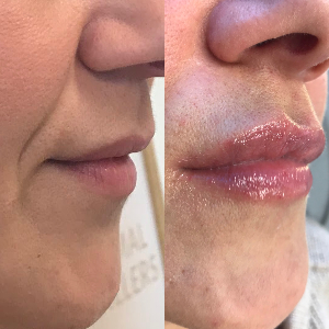 lip fillers before and after example