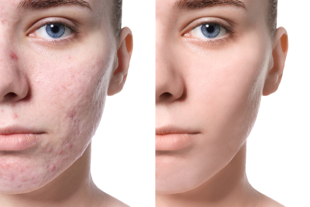 A side by side comparison of acne both before and after treatment