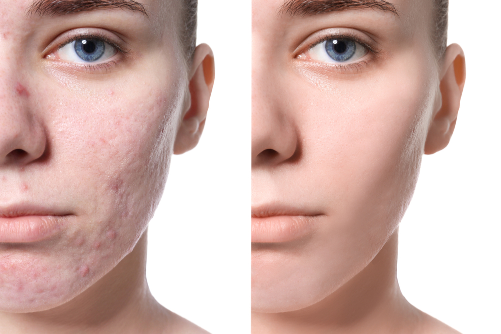 How To Treat Acne Revolution Aesthetics