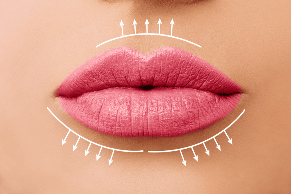 lip filler migration