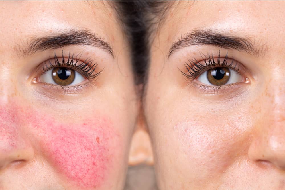 rosacea before and after treatment