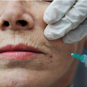 upper-lip-lines-treatment